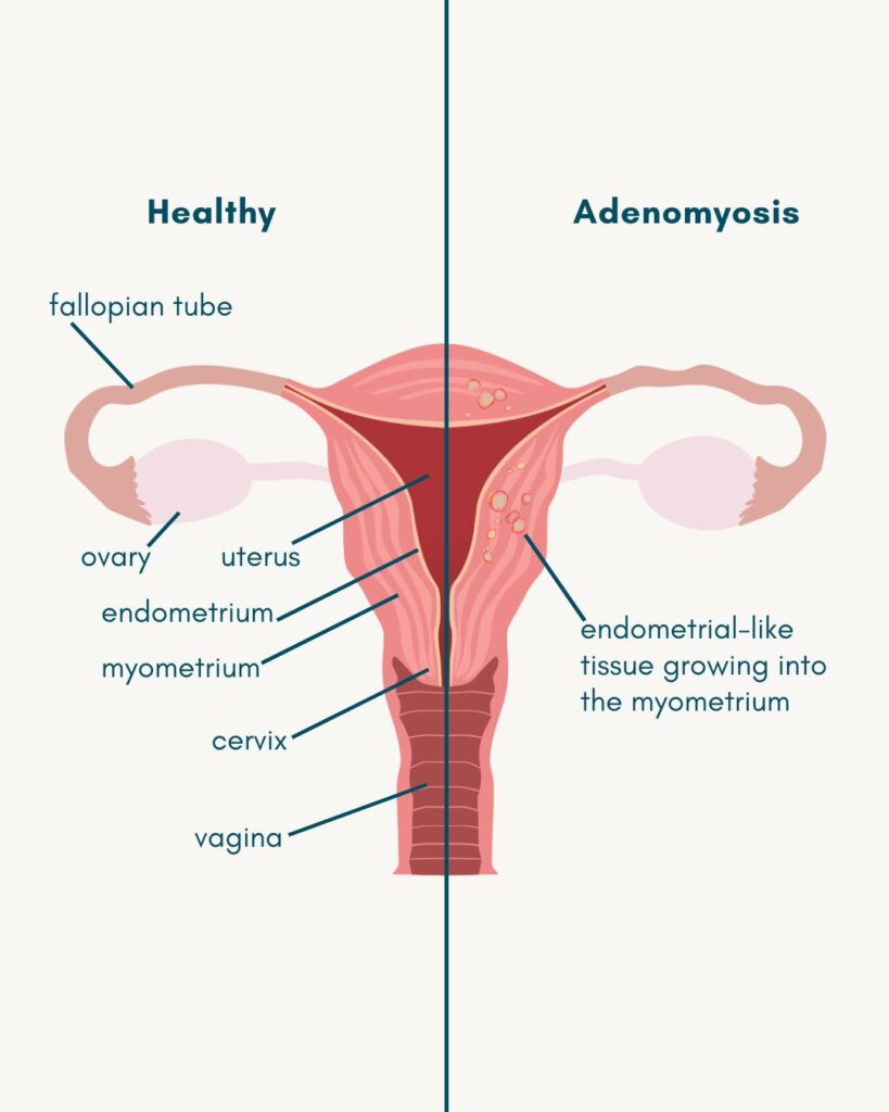 adenomysosis
