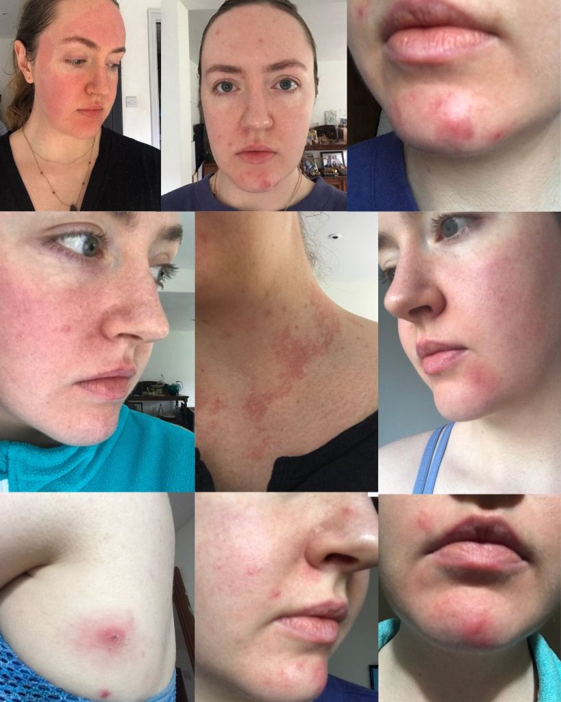 nutritional therapist for acne winchester