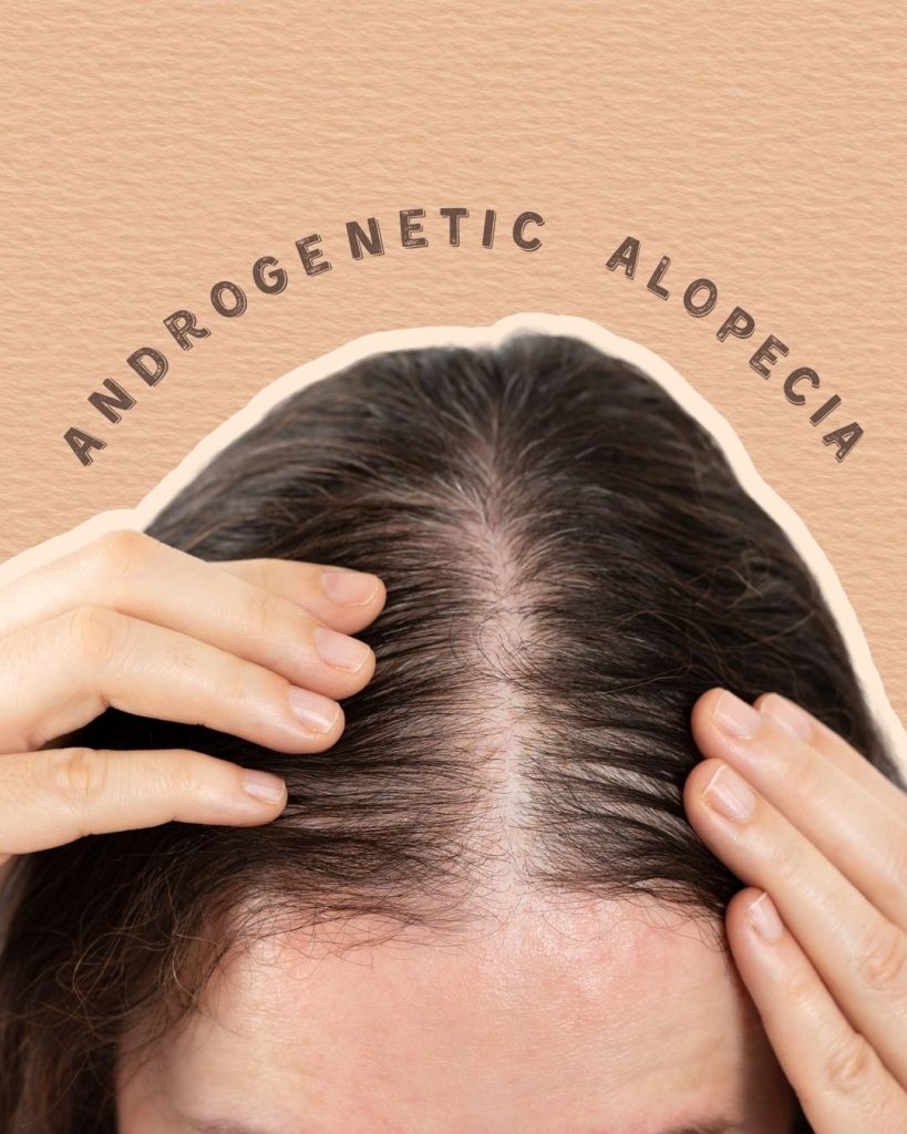 Androgenetic hair loss treatments