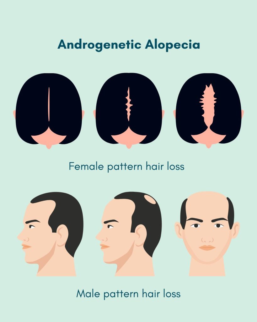 Androgenetic hair loss in men and women