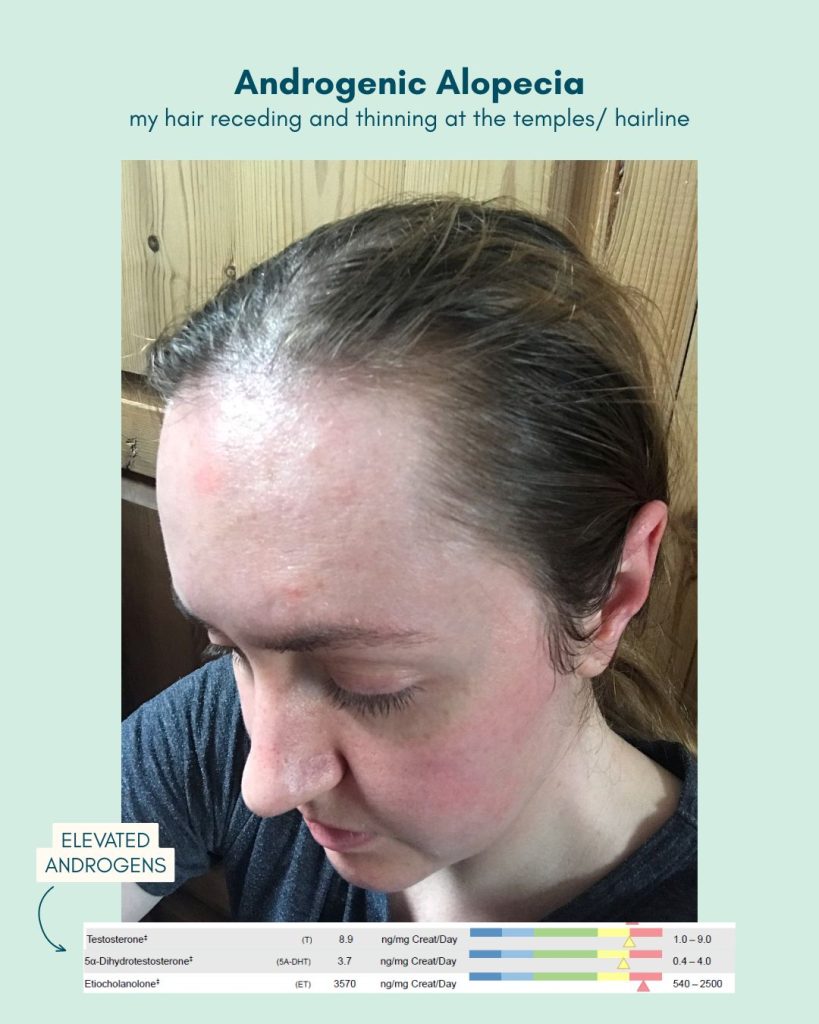 Androgenic hair loss