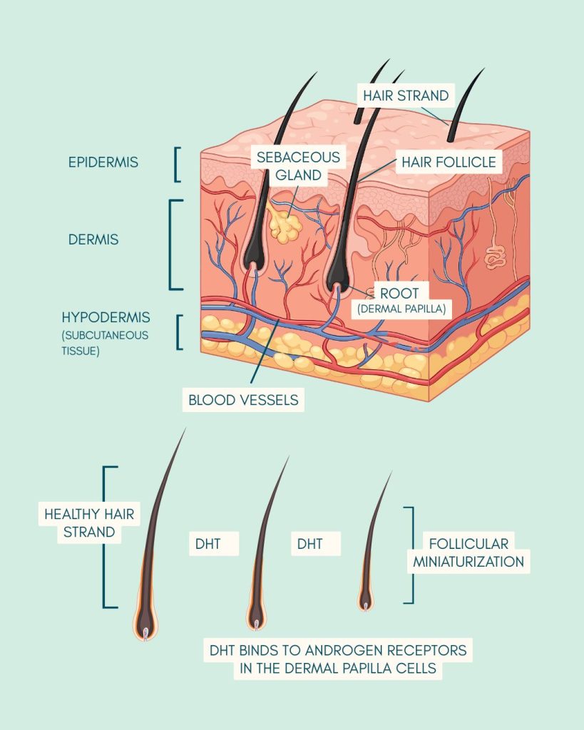 androgenic alopecia diagram